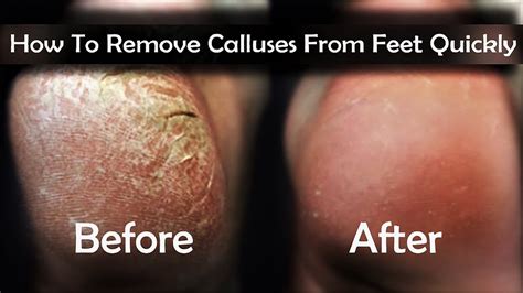 Say Goodbye to Painful Calluses with Nsil Aid